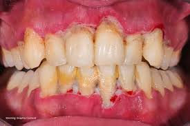 how to cure gum disease without a dentist