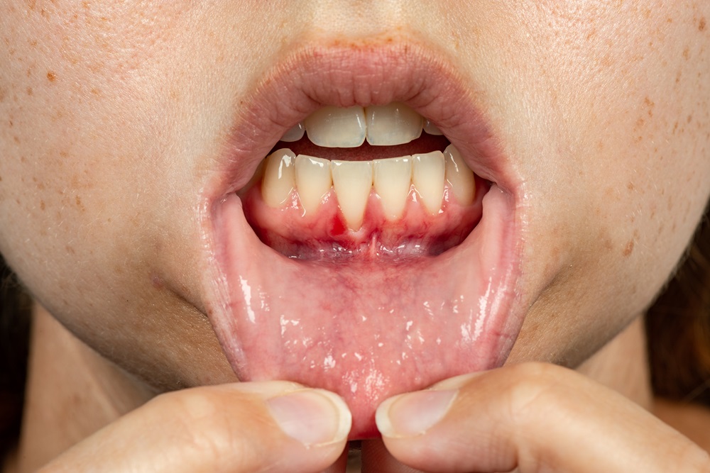 how to cure gum disease without a dentist
