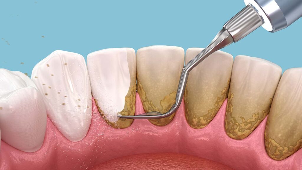 how to remove tartar from teeth without dentist