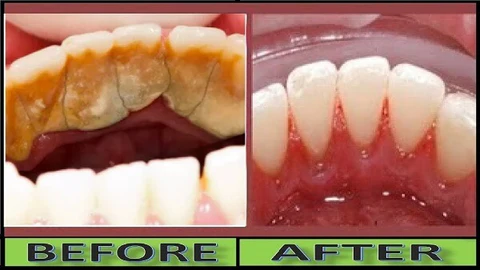 how to remove tartar from teeth without dentist